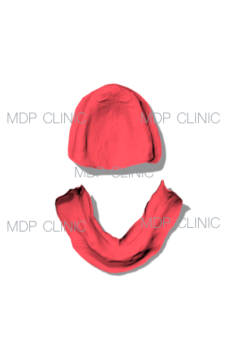 Assenza di impianti in Arcata superiore, 2 impianti in arcata inferiore con attacchi sferici per la Protesi Rimovibile Inferiore